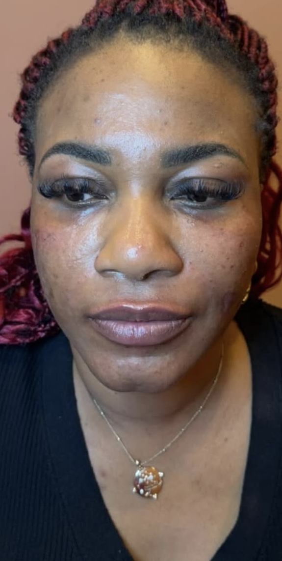 Smile line after treatment
